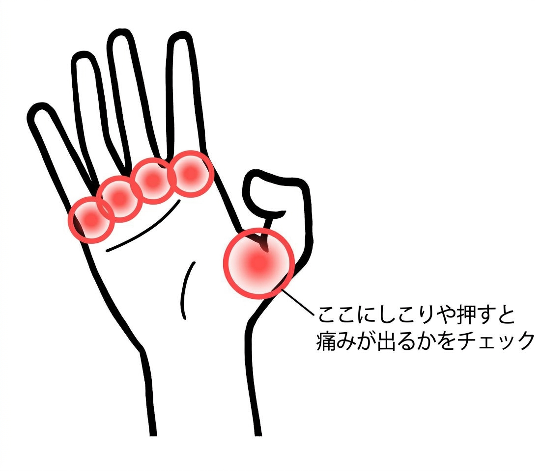 手のひら側から見た手のイラスト。四本の指のつけ根と、親指のつけ根に赤い丸がつき、しこりや押したときの痛みを確かめる場所を示している
